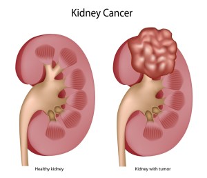 kidney-cancer