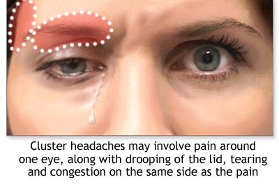 cluster-headache